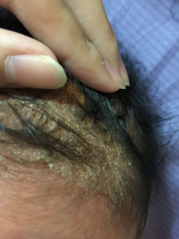 頭皮屑 媽咪愛 育兒問答