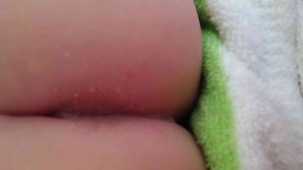 寶寶屁屁有顆粒