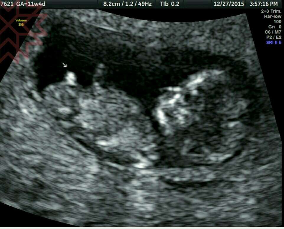 懷孕11週4天 醫生肯定的說出寶寶性別 真的可以那麼早確定嗎 媽咪愛 育兒問答