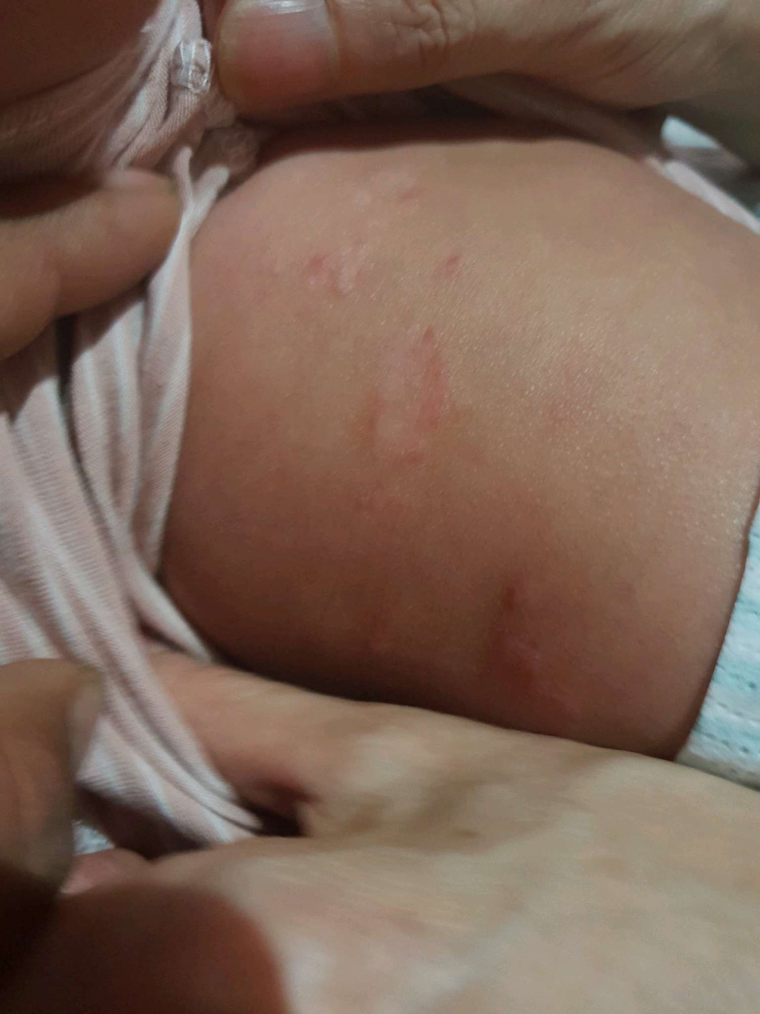 嬰兒腋下這是什麼?