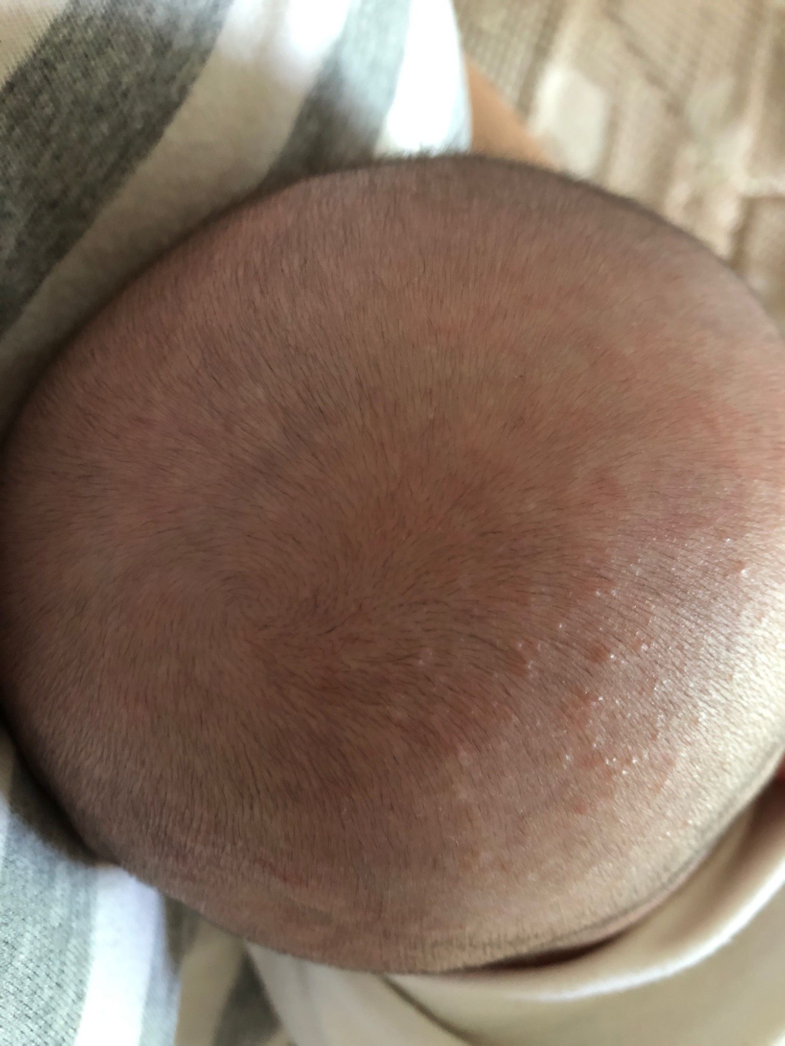 寶寶頭上長一顆顆