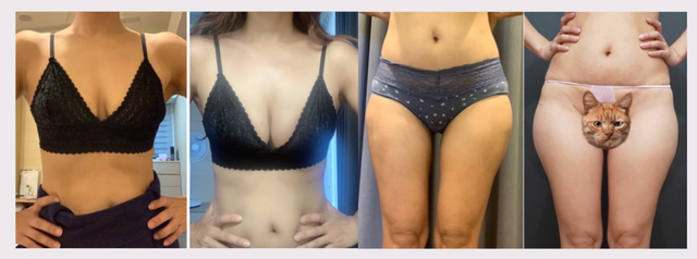 想要更自然的話可以考慮自體隆乳
我自己是做自體隆乳
我把馬鞍肉拿去補胸，我的馬鞍肉太肥了
手術完後面恢復後很自然，馬鞍肉也消失了，線條也修得很好看
胸部不止罩杯升級了兩個cup，整個很滿意
我是在台中馨美美學做的
醫師是余宗宸，是專精抽脂的名醫
因為有先查過這個醫師是專門做重修的技術很好
查了他的案例也都很漂亮就給他做了
分享我術後差異給妳