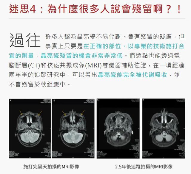 晶亮瓷殘留這件事情完全就是誤解．．．已經有很多研究證實過了
它既然能被核可上市做使用，就代表它的安全性是經過驗證的，不需要再自己庸人自擾啦
我反而覺得自體脂肪在額頭跟夫妻宮這一塊的存活率很低，朋友去做過，大概一個月就流失光了，感覺很浪費錢．．．