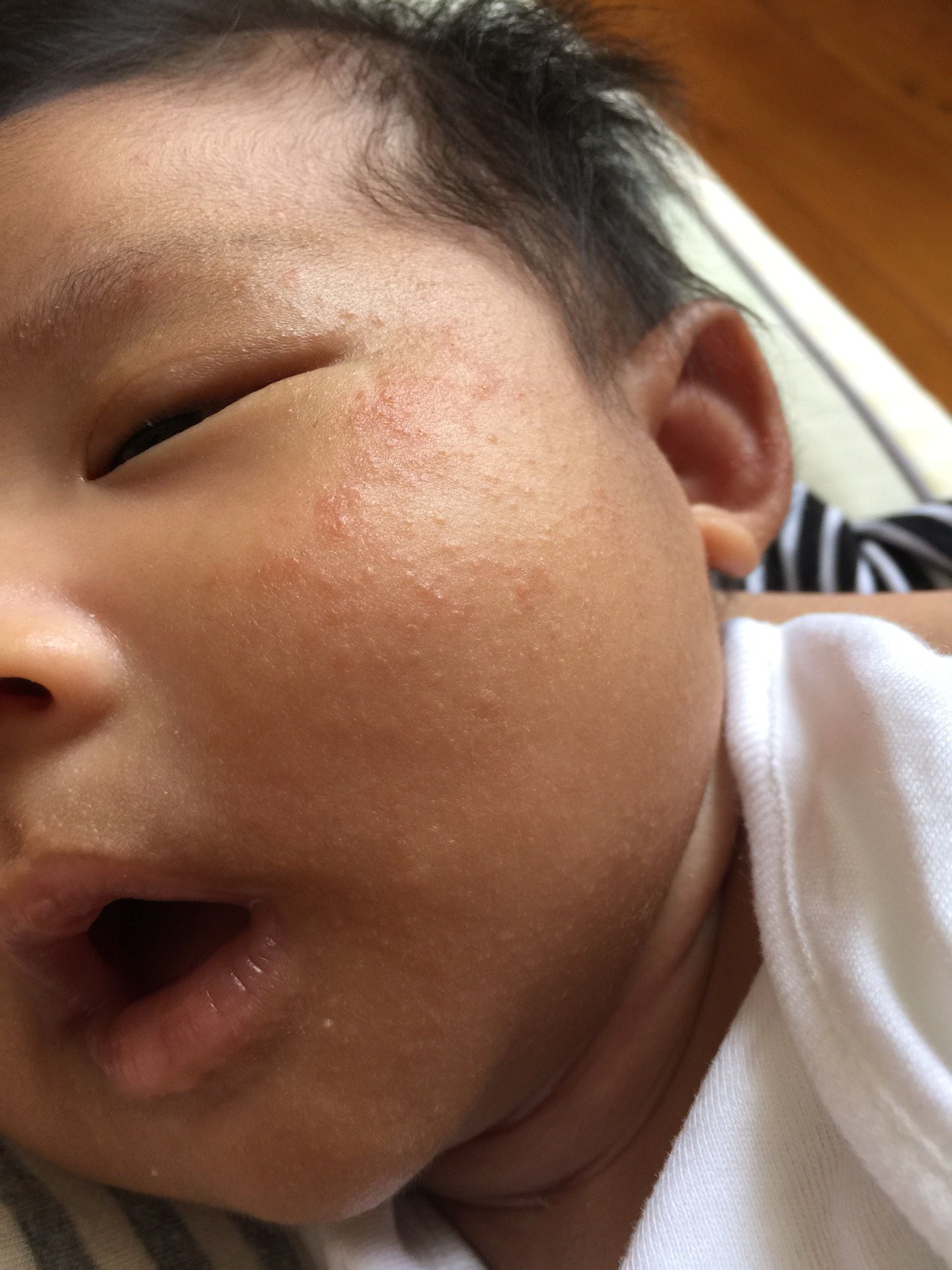 寶寶皮膚紅疹