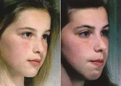 孩子「口呼吸」影響超乎想像,提醒家長們千萬別忽略