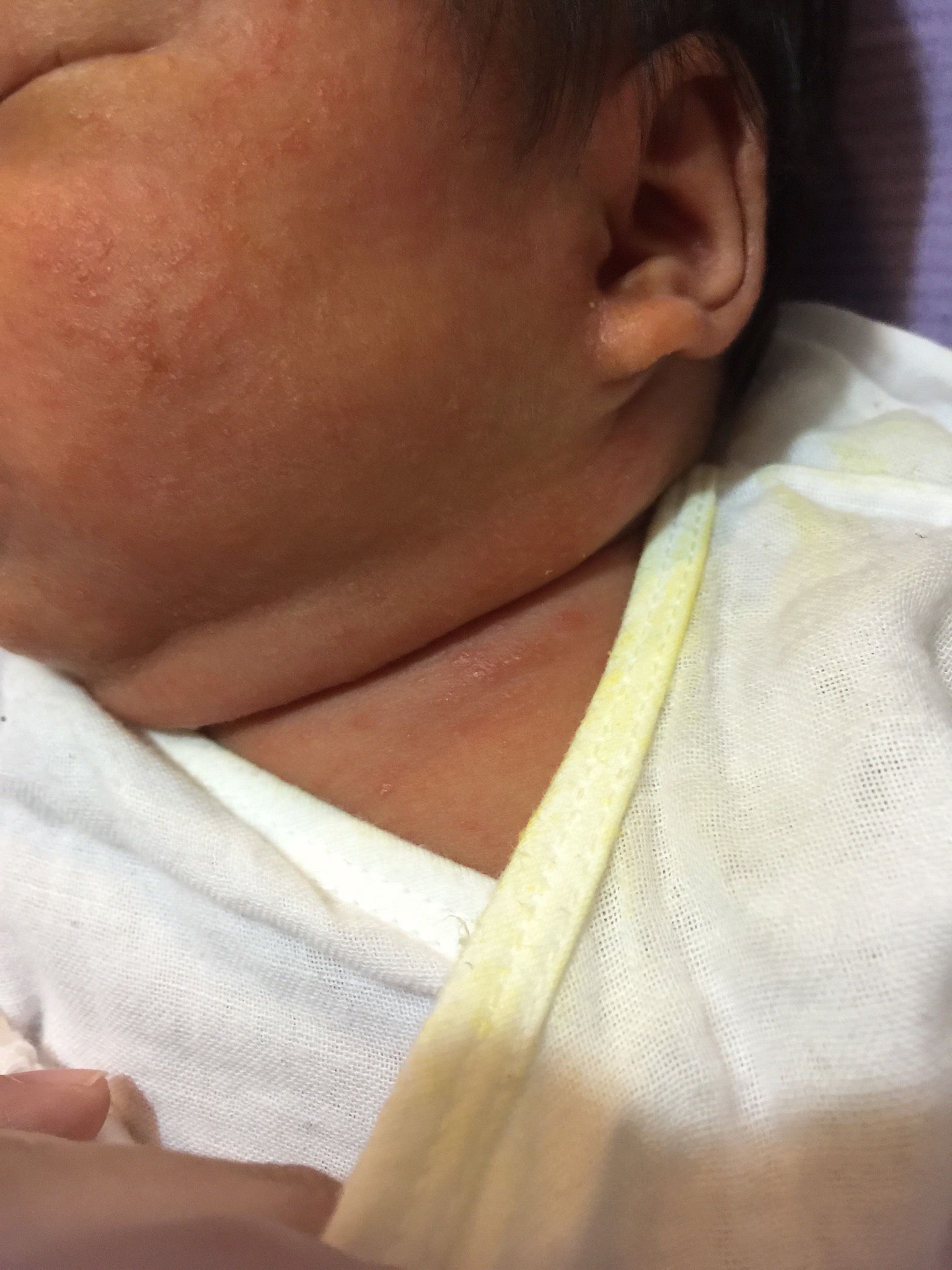 寶寶臉上脖子上疹子 還有脖子黃黃