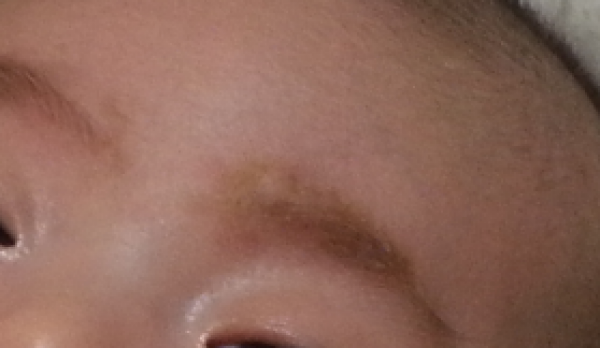 寶寶眉毛脫皮