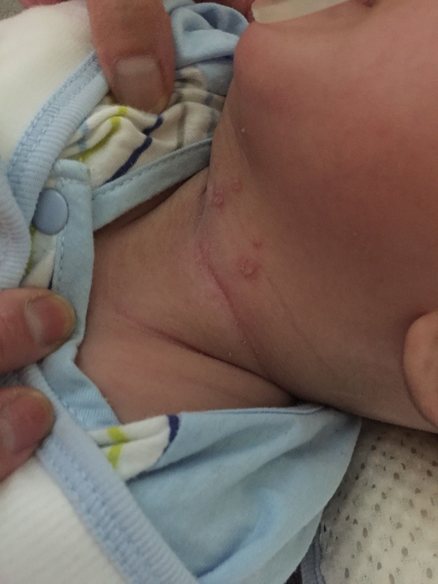 脖子長的是水泡嗎？