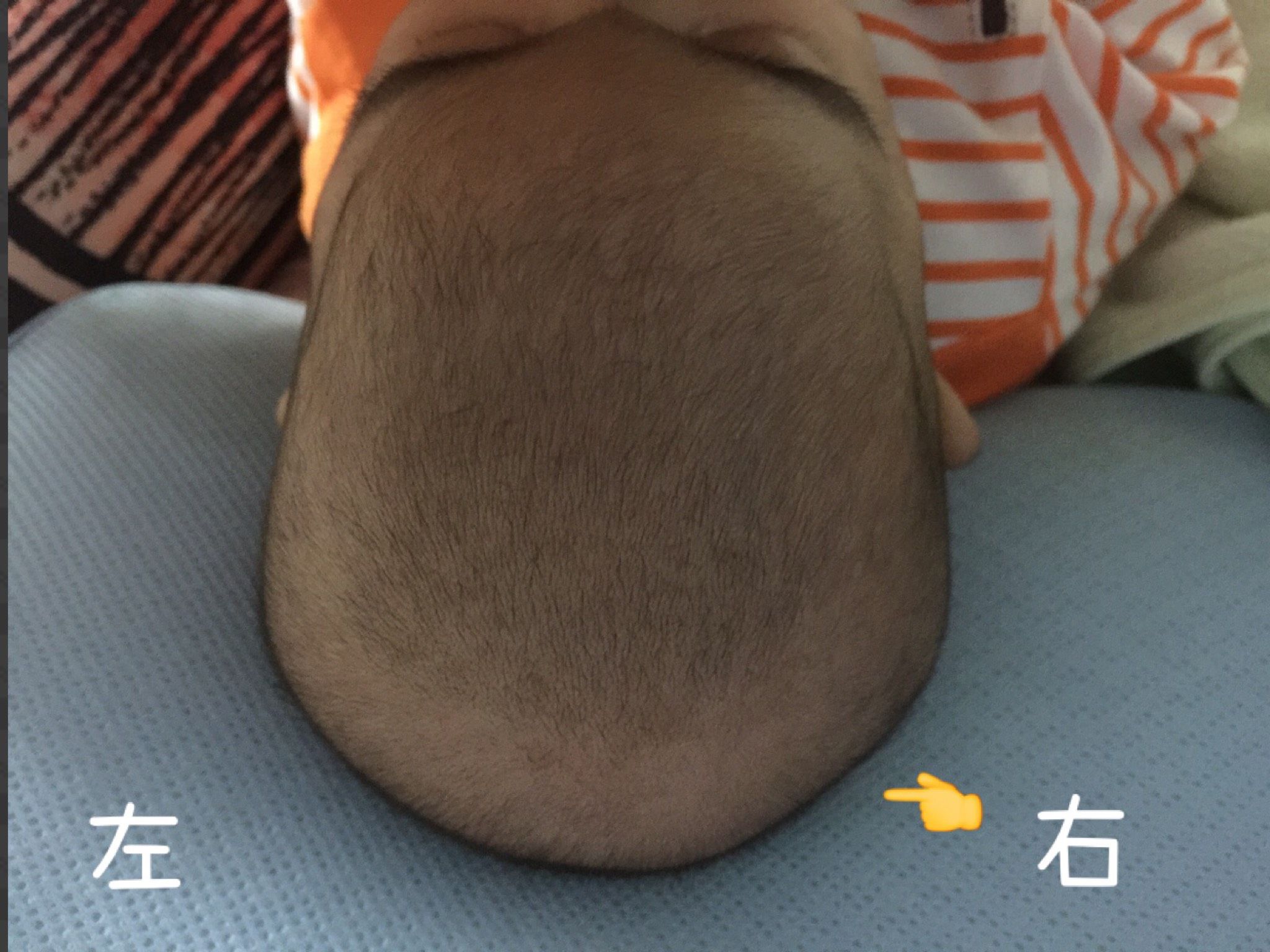 寶寶頭型的右邊是平的⋯