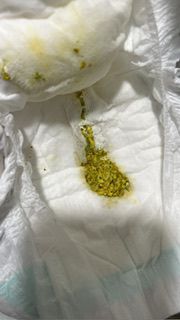 寶寶喝配方奶一天10幾次大便正常嗎