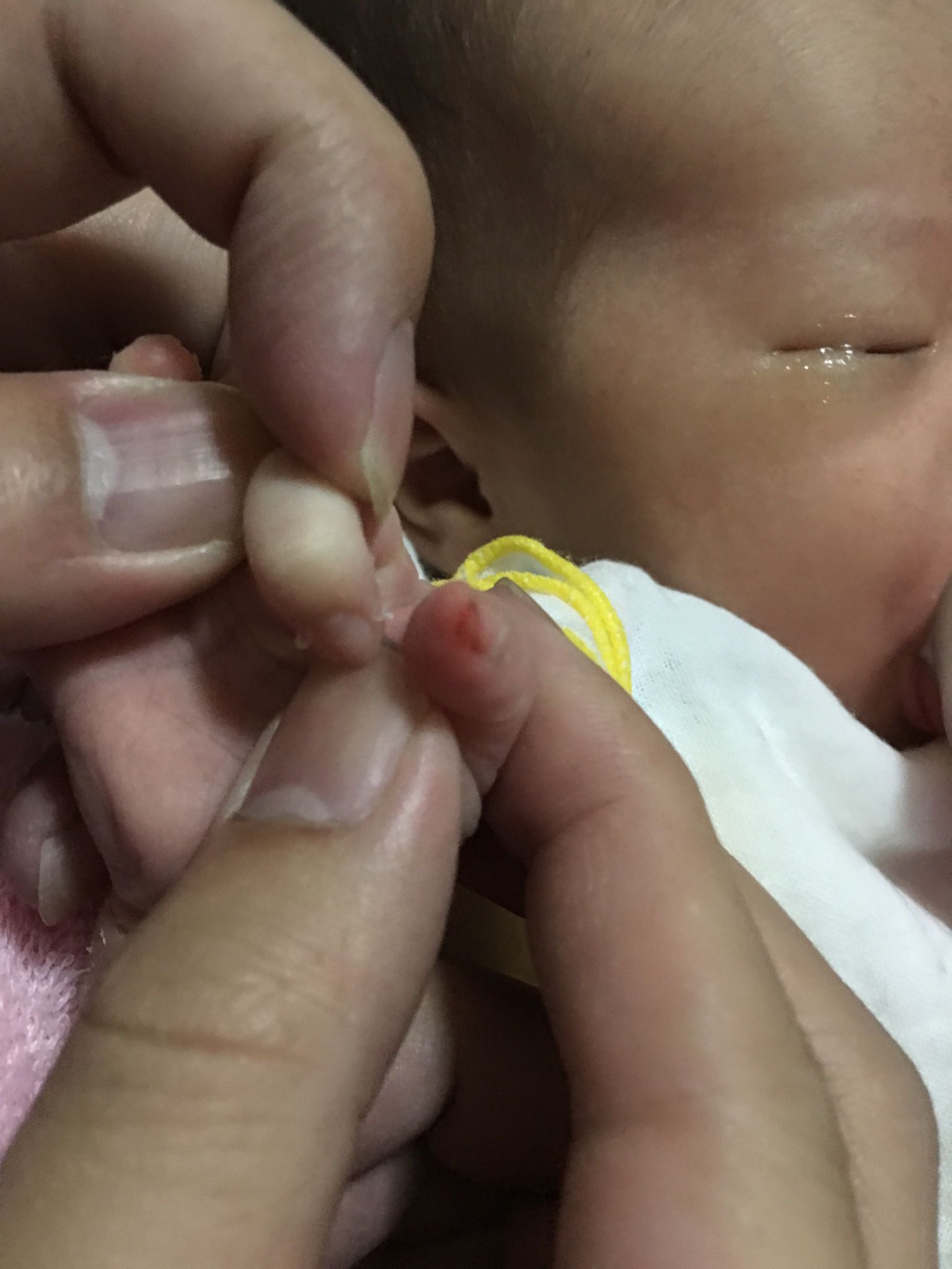 寶寶剪指甲流血了