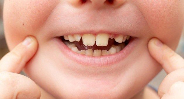 小孩牙齒長歪怎麼辦？兒童牙齒矯正器推薦隱適美還是傳統牙套？