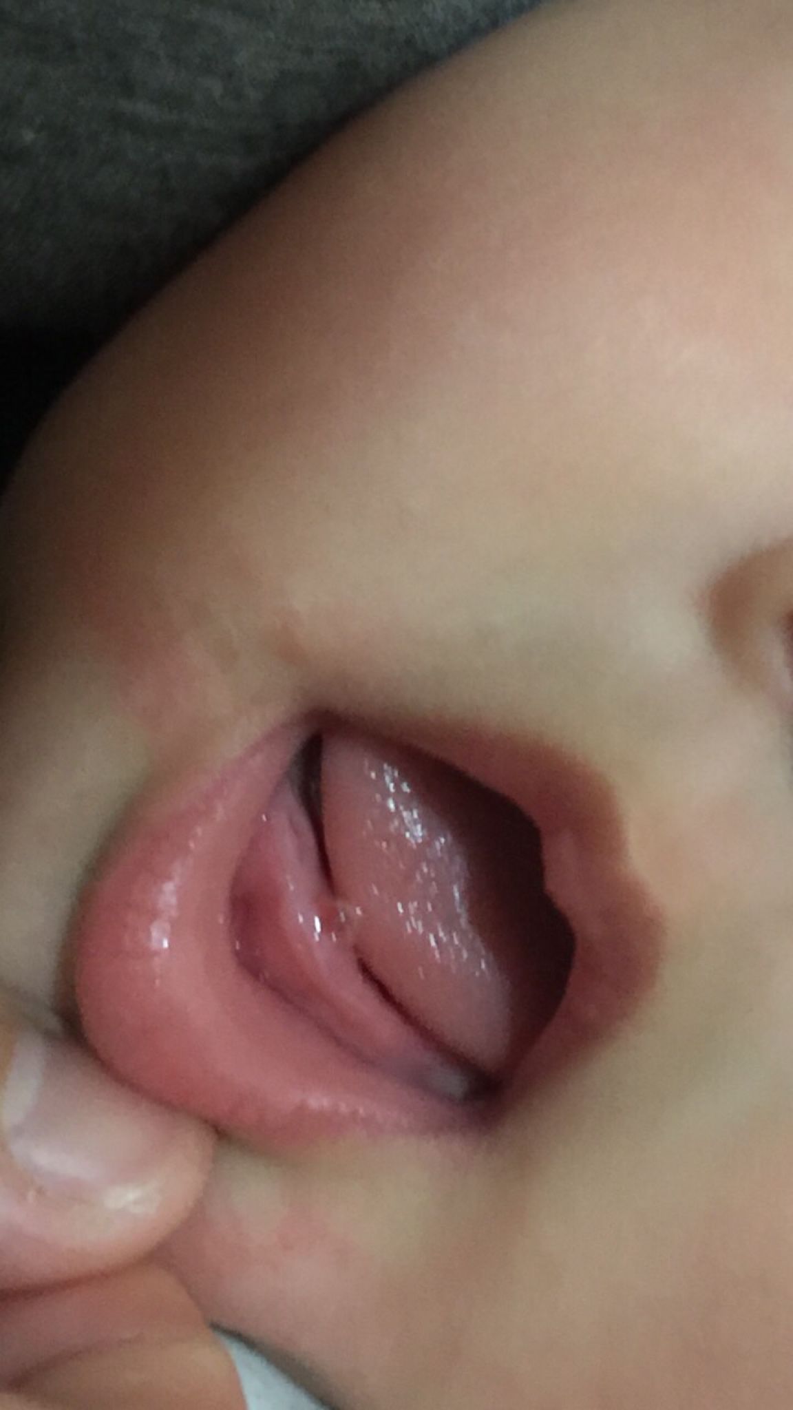 牙齦長小水泡