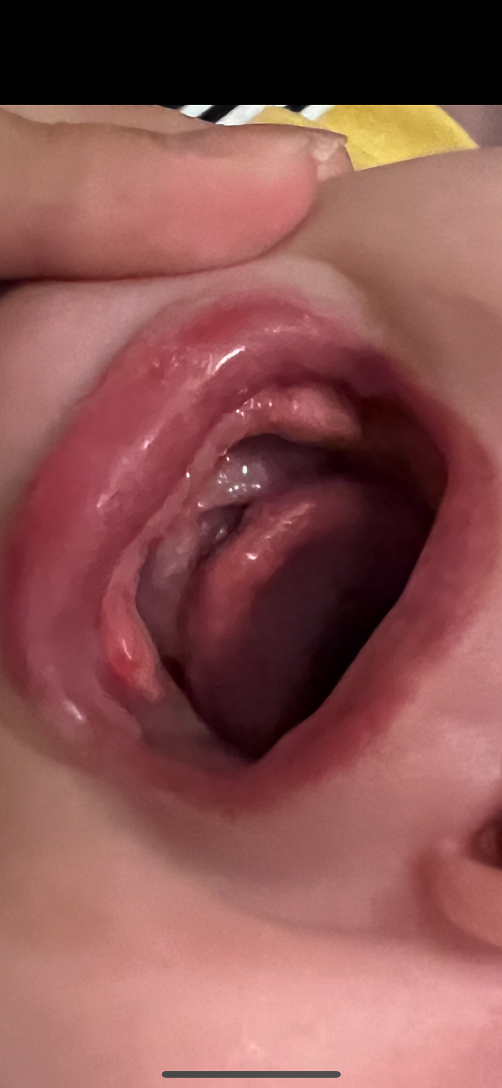 寶寶牙齦長了顆水泡