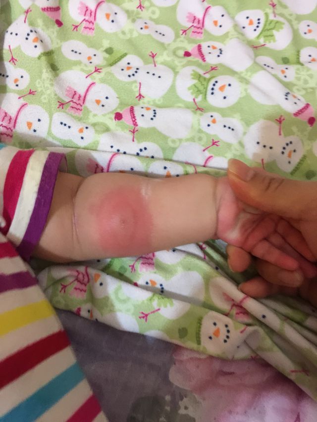 我家的也是被叮、很嚴重我還帶去看醫生勒、醫生也只開藥膏抹而已、我就把家中的藥隔段時間就抹ㄧ種、只要能消就好