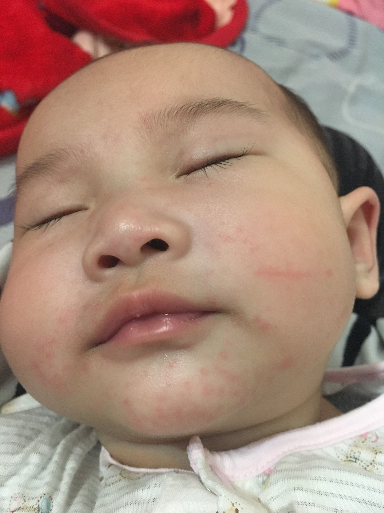 這是口水疹還是太熱呀？