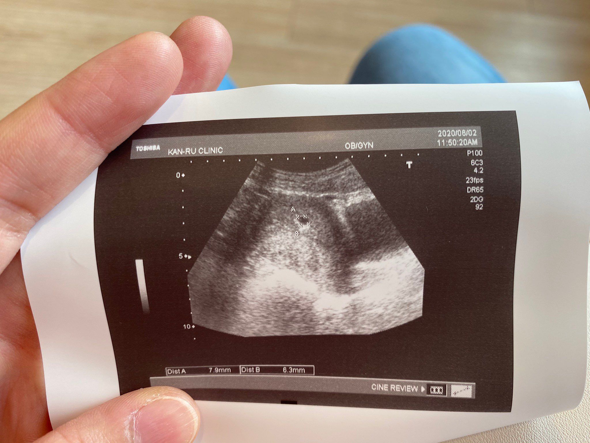 照到胚胎5週囉～