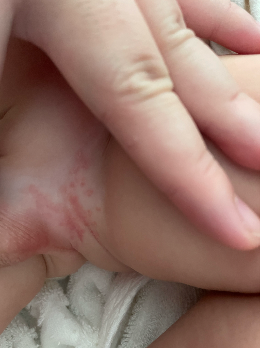 蛋蛋旁邊鼠蹊部有紅疹，跟股溝，換過尿布品牌擦藥但還是一樣