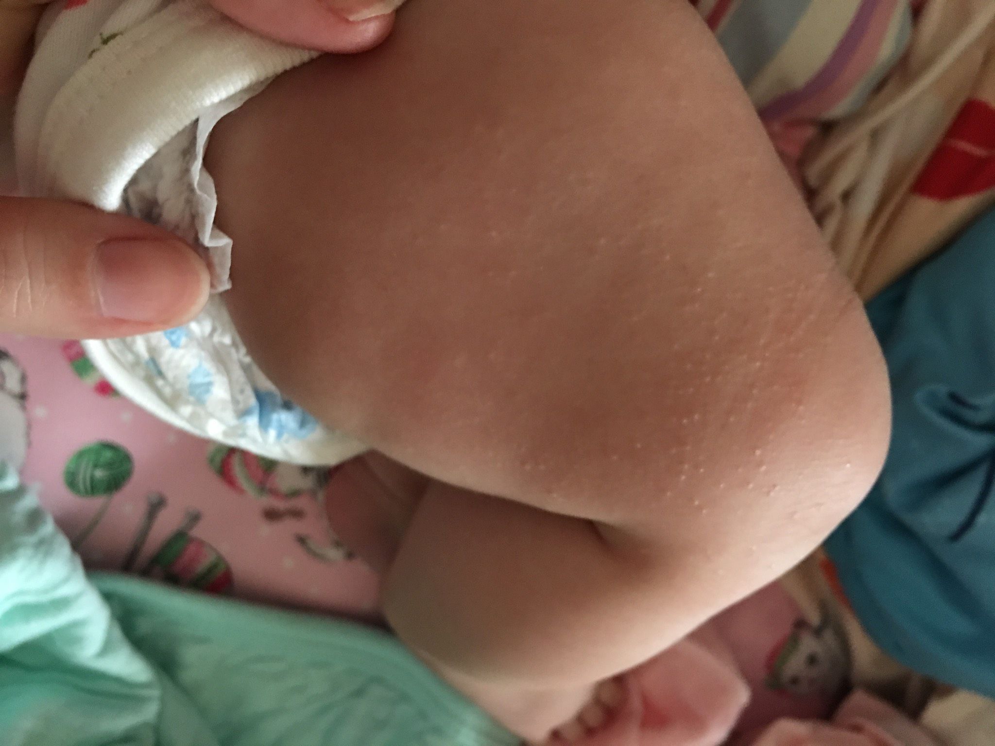 現在三個月發現大腿有粒狀的疹子