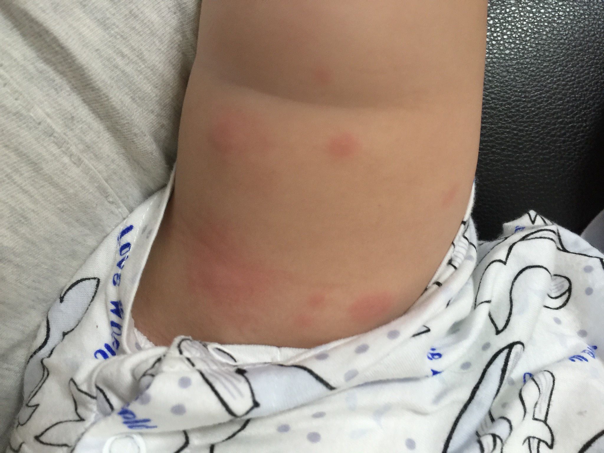 寶寶身上出疹子