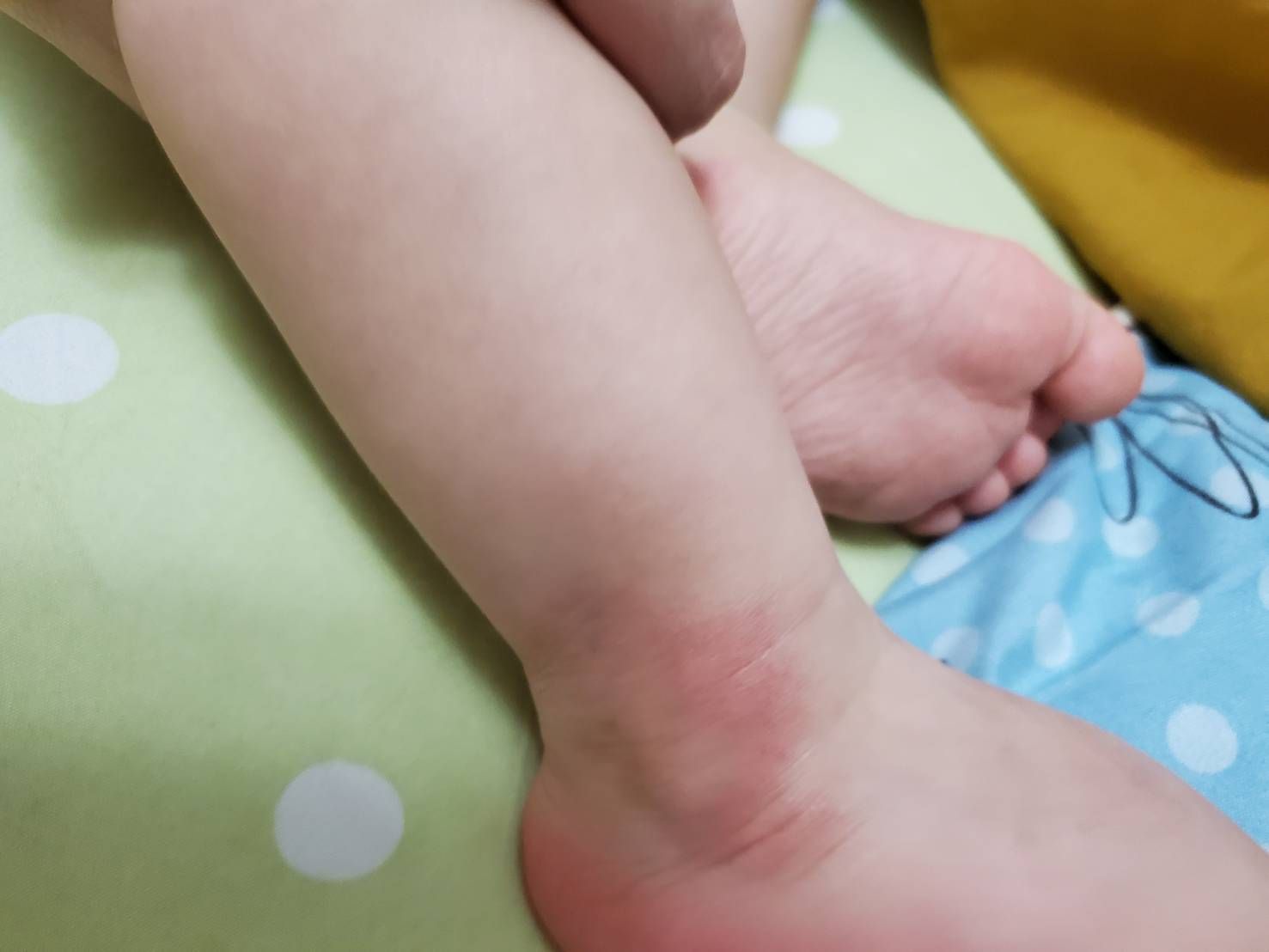 寶寶熱疹\異膚\黴菌 是不是很難分辨Orz
