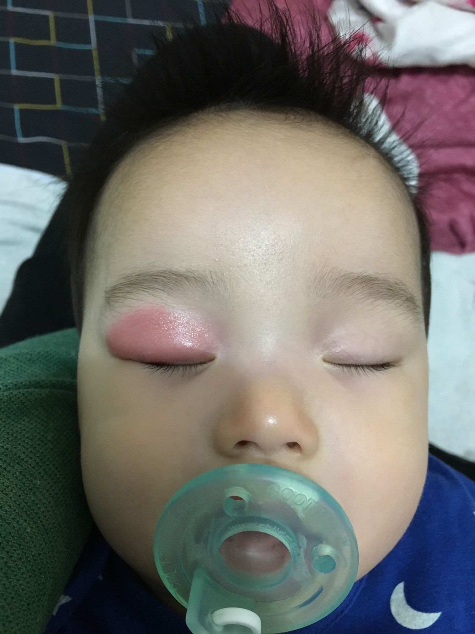 寶寶眼皮被不明蚊蟲咬，求解藥？