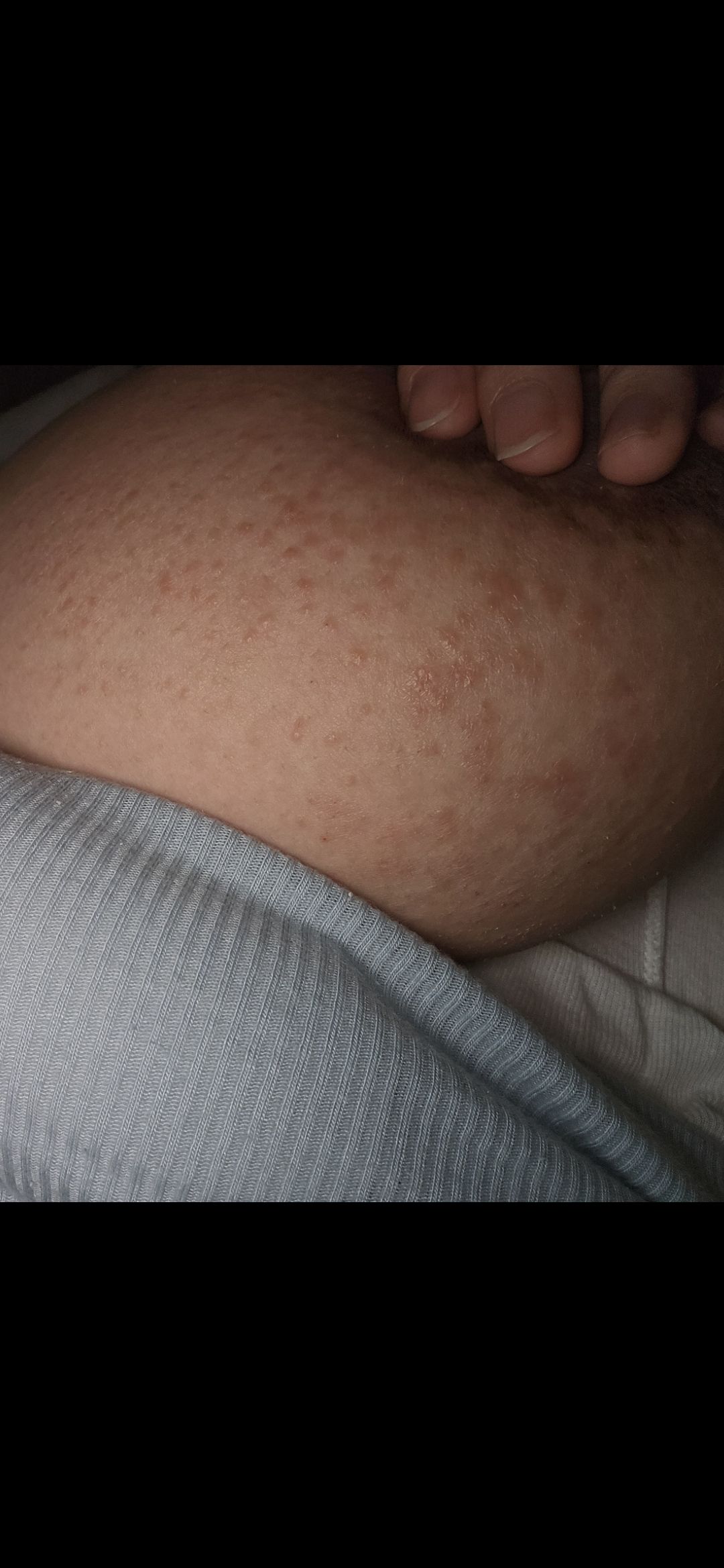 哺乳乳房起疹子