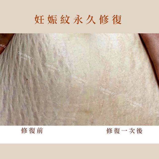 媽咪妳好～
我是一名皮膚修復師
操作的是法式永膚術，可以有效的永久修復紋路
可以私訊我為妳提供協助。
@528uxodk