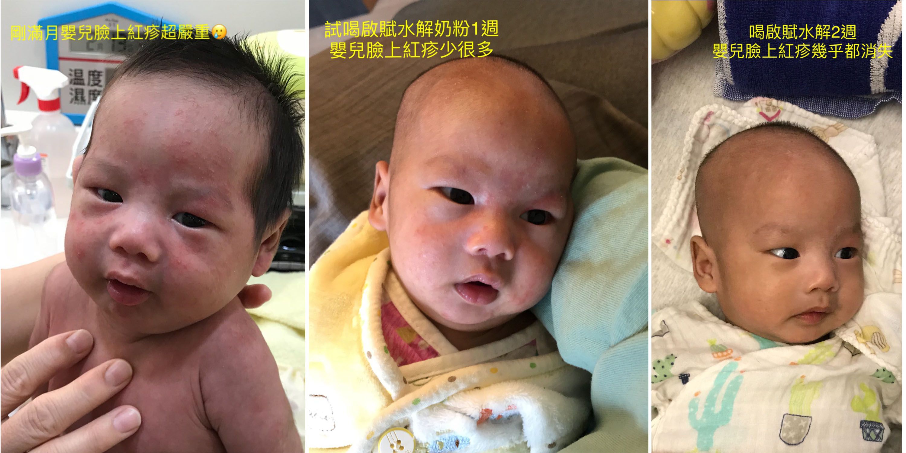 嬰兒臉上紅疹好心疼！常見6種寶寶皮膚過敏紅疹～該如何照顧呢?