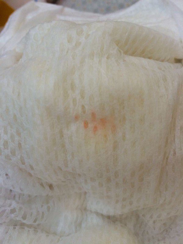 尿布好像有血？！