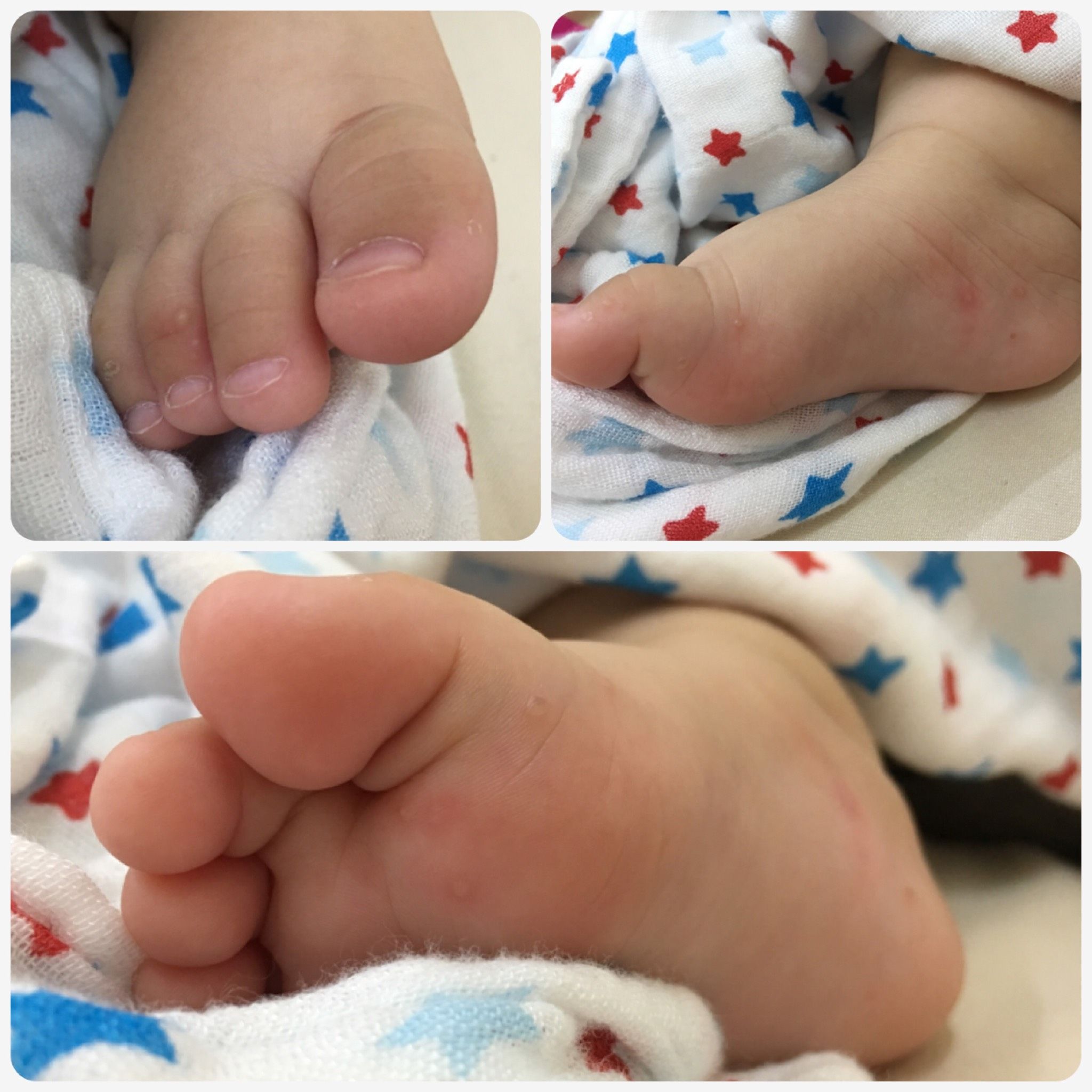 寶寶的腳生白色一粒粒的疹子