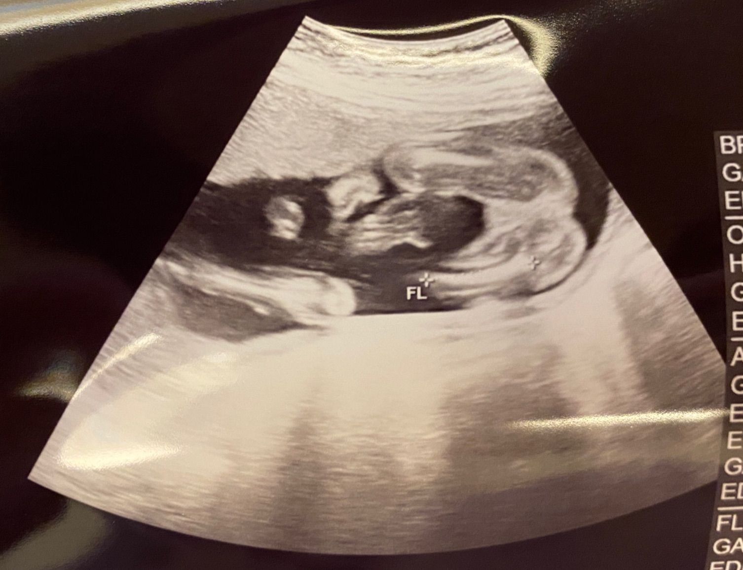 大家來猜猜看~超音波照這是男寶~還是女寶