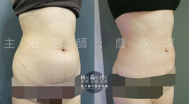 抽脂跟減肥還是有點不同
如果你是想要局部瘦的話那就去抽脂
像我就是肚子一直減不下來
後來是去楊氏診所評估後決定抽脂
過程沒有我想的那麼可怕,術後也恢復的還不錯~