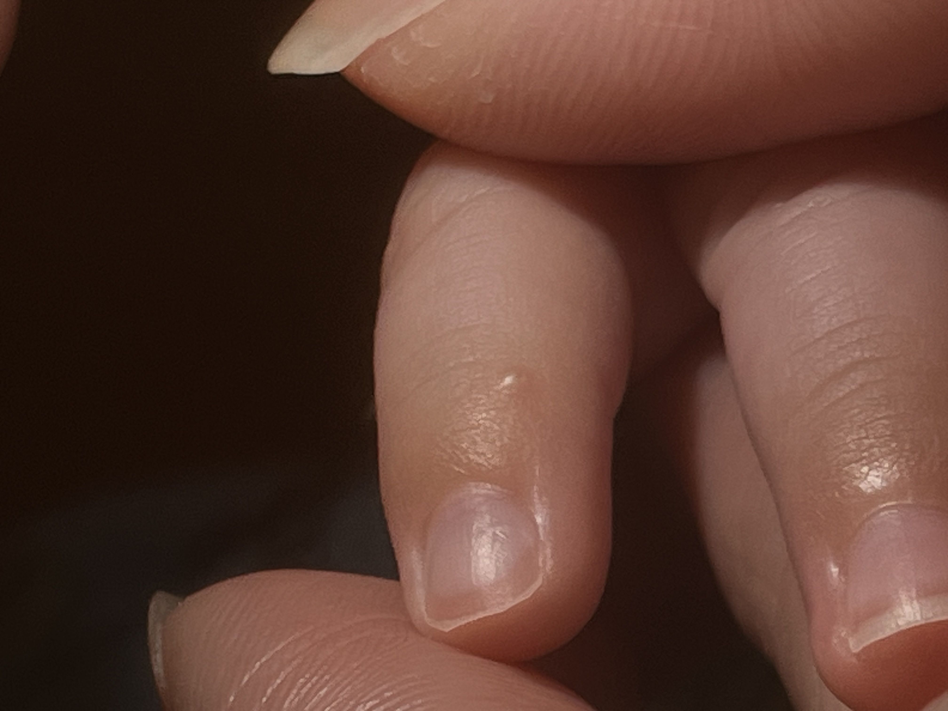 我想請問寶寶手指長一顆水泡是什麼