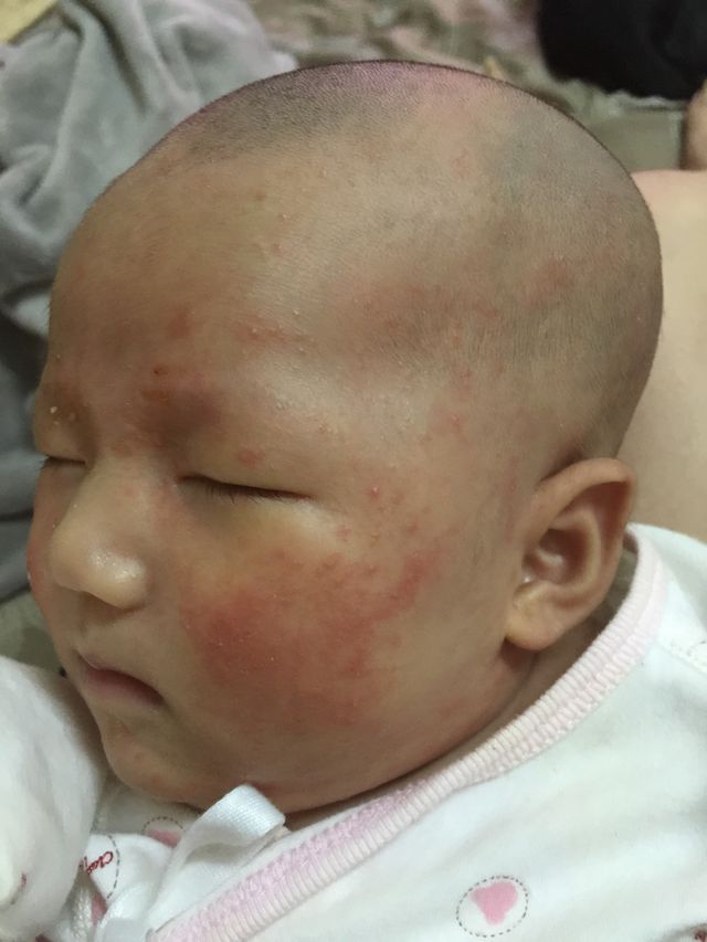 請問版媽..你是怎麼讓寶貝好的..我女兒已經長了大概一個月..而且不知道是不是天氣比較乾所以最近好嚴重..今天打針結果他自己手去抓到就流血了！