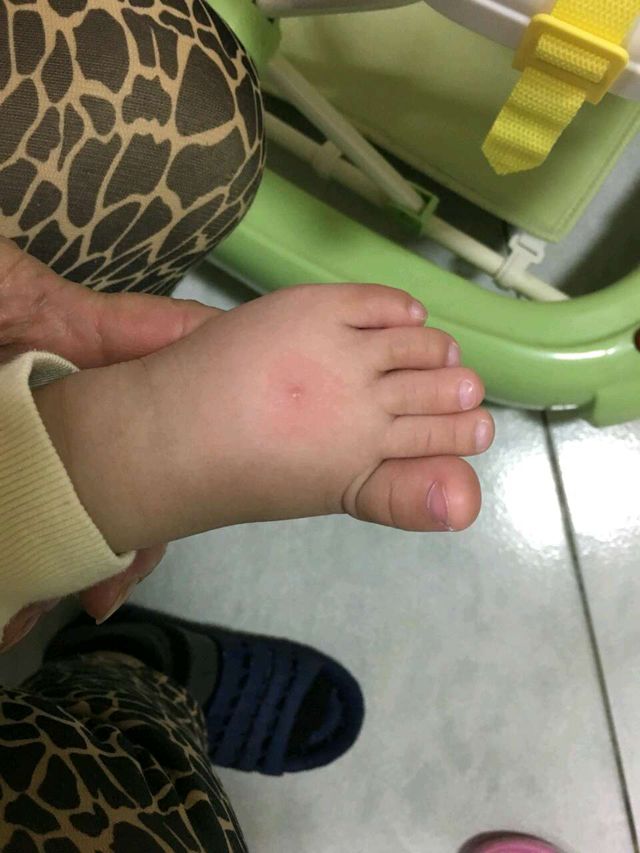 另一處被咬