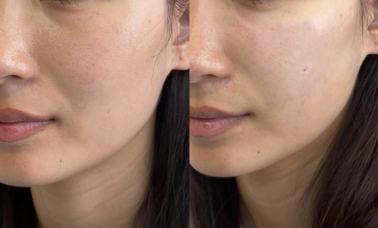 #分享 熊貓針改善黑眼圈|媽媽也能漂亮不憔悴