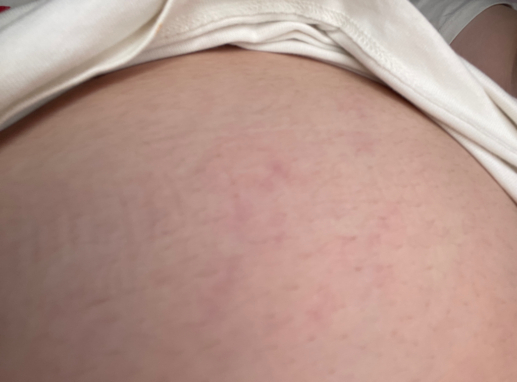 6個月就長妊辰紋