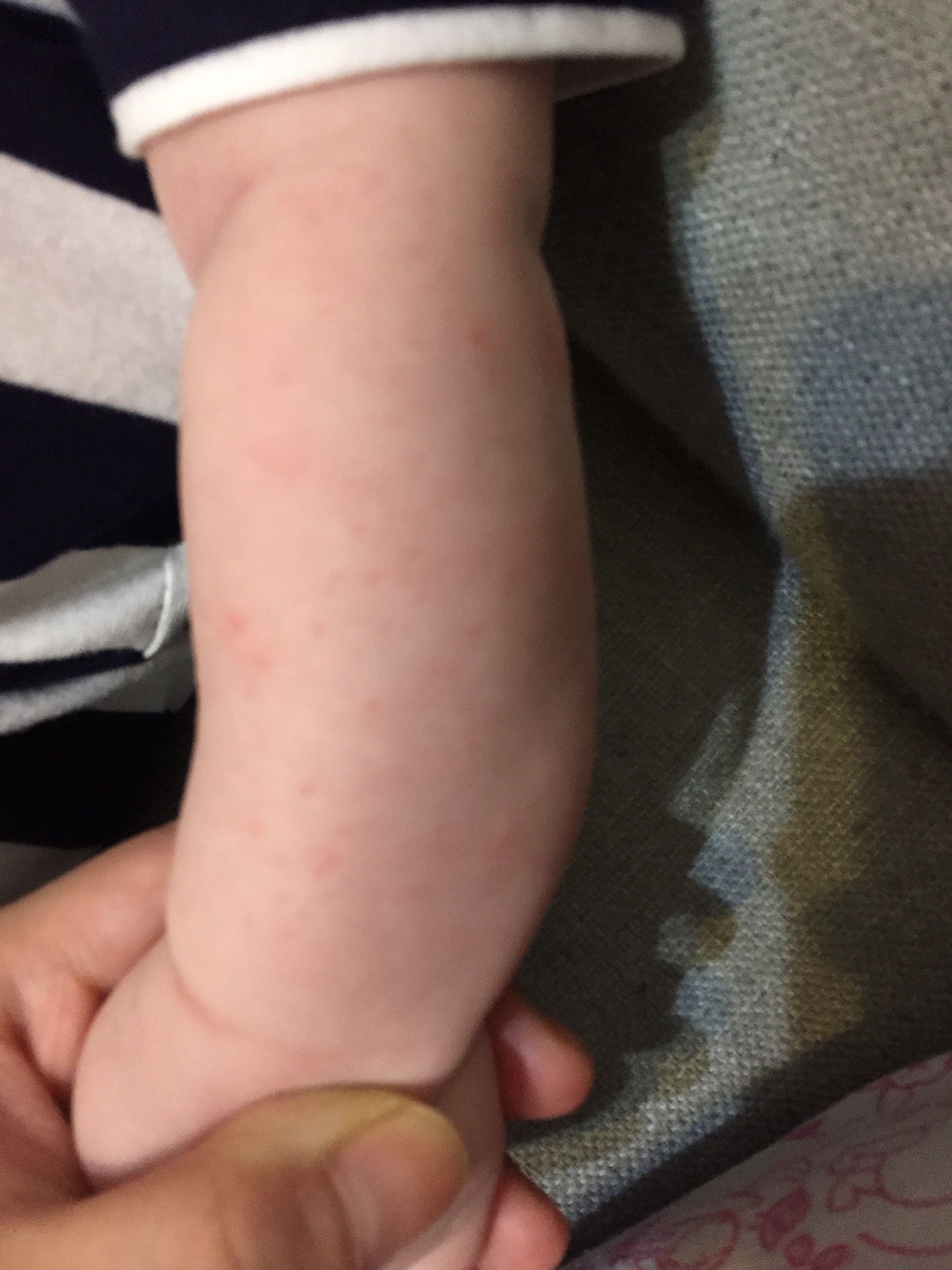 請問各位媽媽這是汗疹嗎