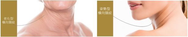 脖紋(頸紋)救星出現!Juvelook喬雅露 台灣醫美瘋搶,