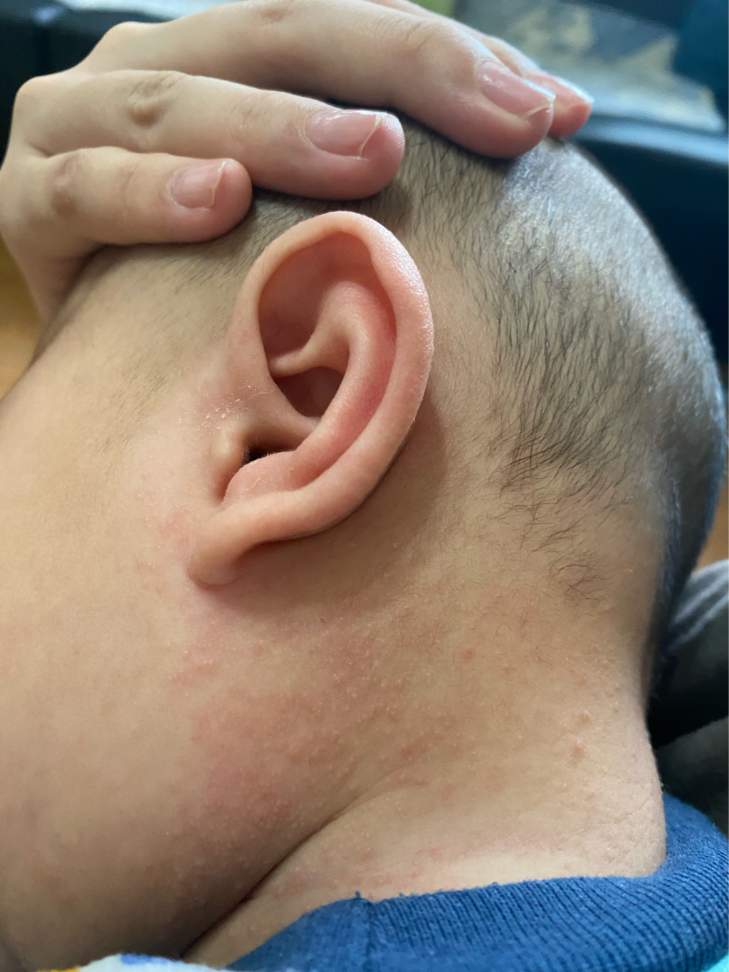 寶寶口水疹&濕疹 媽咪們有建議的乳液或是護膚膏嗎