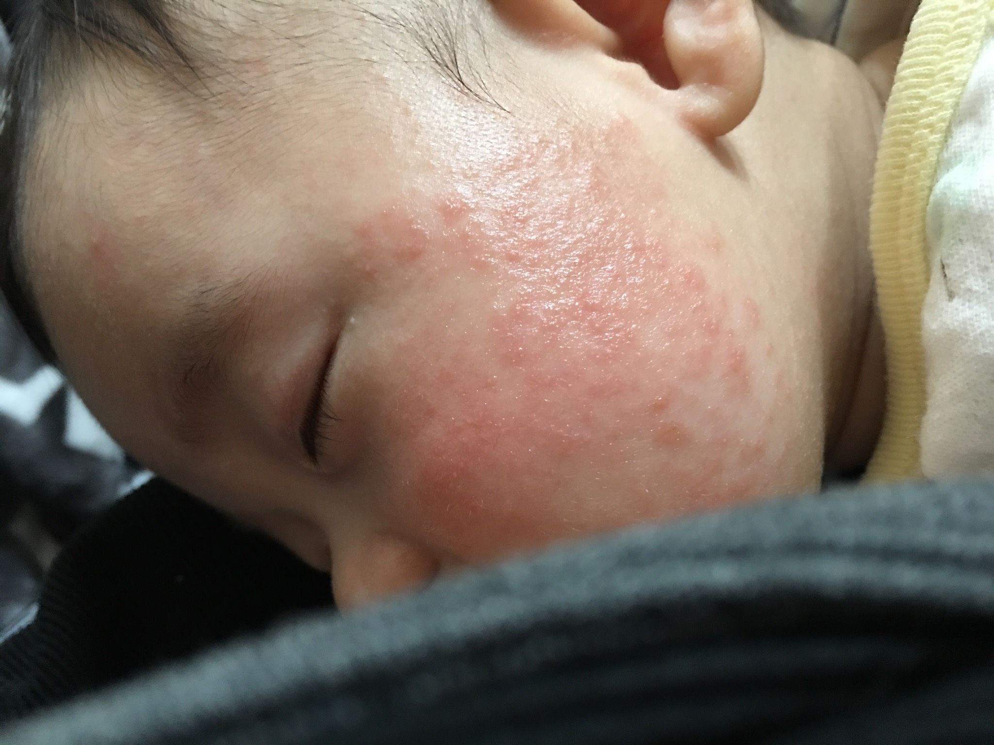 寶寶臉上紅疹