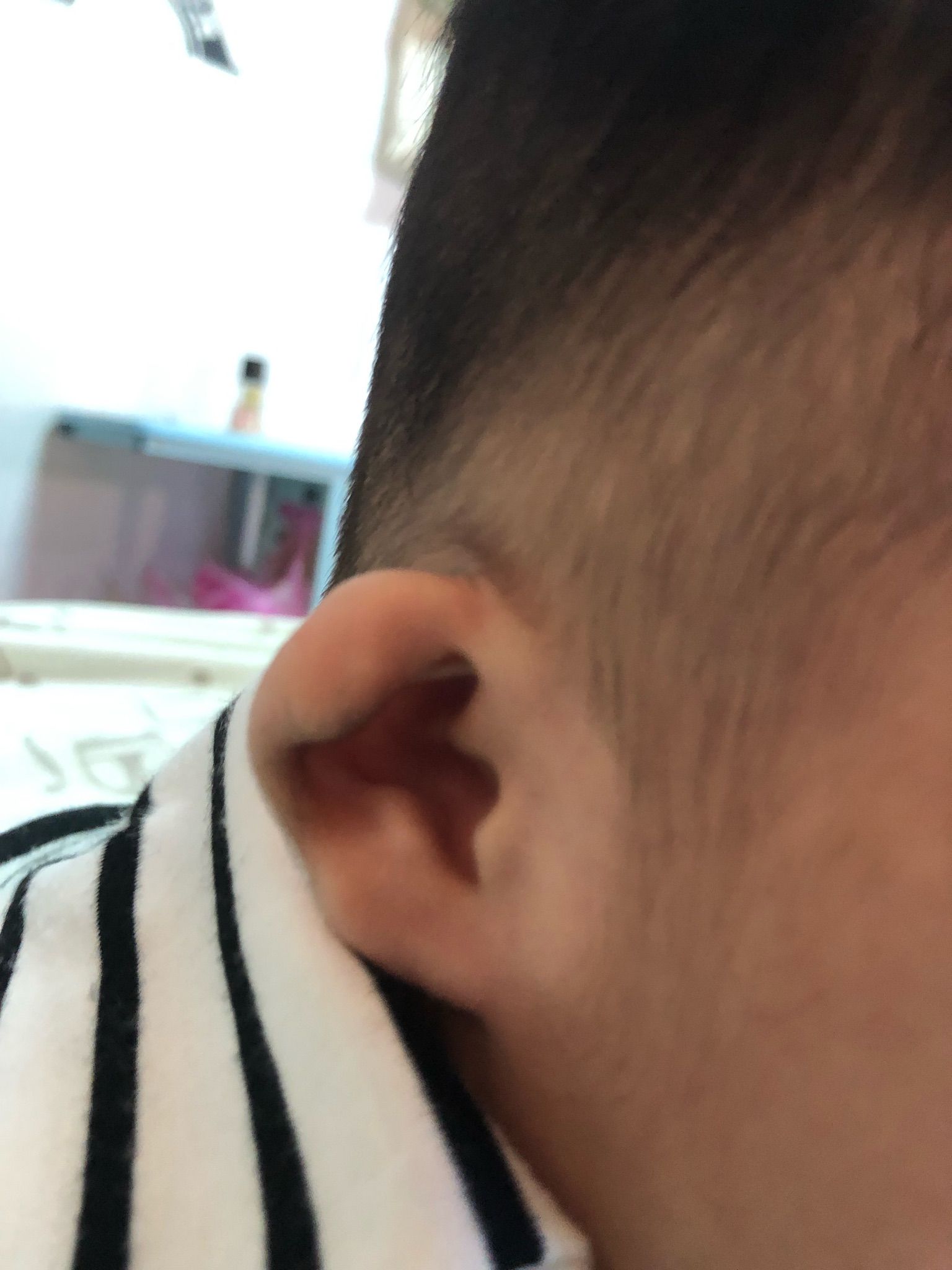 耳朵3個月多還沒恢復正常嗎？