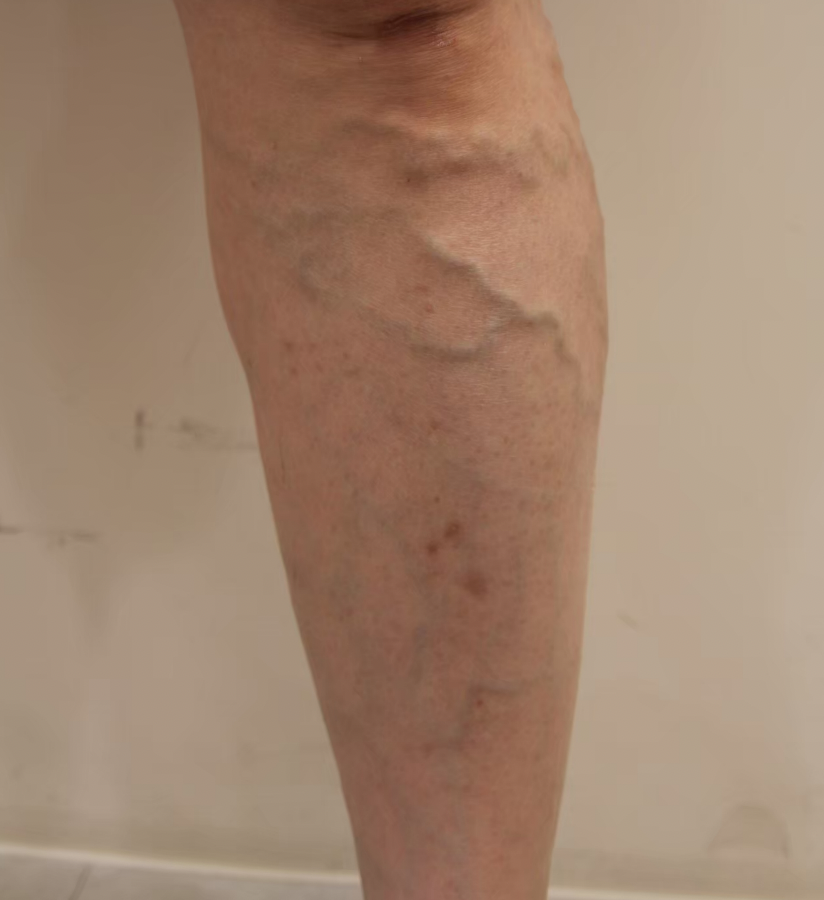 孕期中腿部出現靜脈曲張