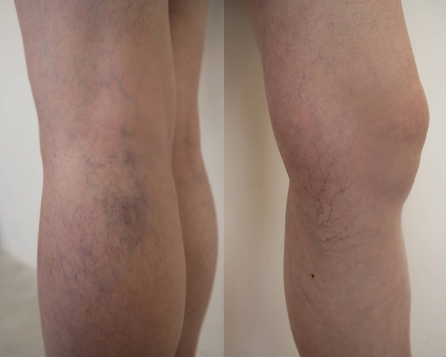 求助產後小腿靜脈曲張