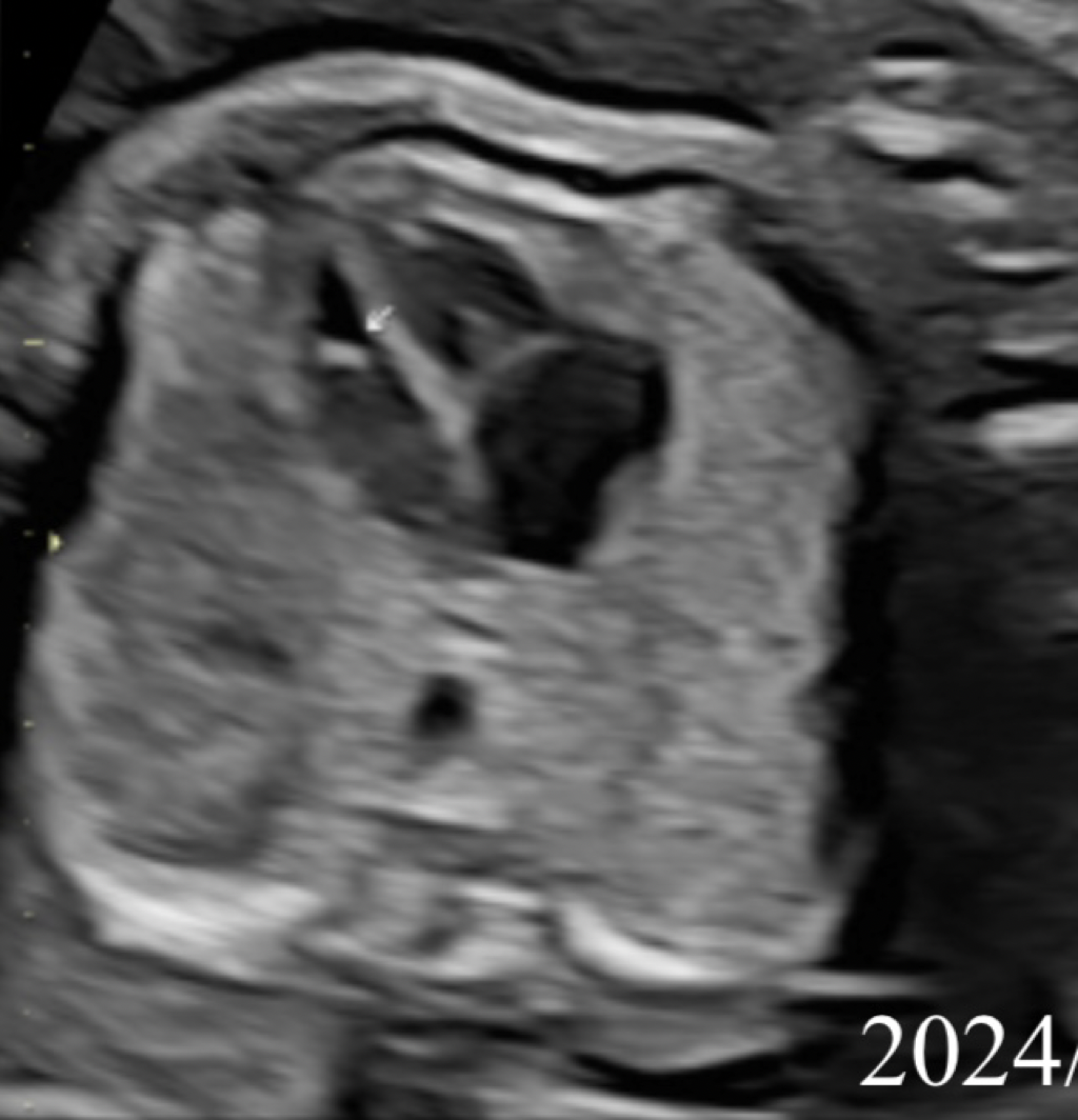 請問各位高層次發現小白點及VSD(心室中膈缺損)建議羊穿嗎?