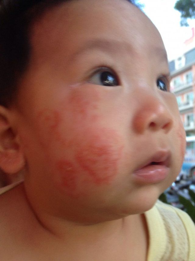 建議媽咪帶去給皮膚專科醫師看唷，我兒子也是異位性皮膚炎很嚴重晚上都睡不好。

我原本以為要多洗臉，還跑去買天然的肥皂幫他洗，結果越來越嚴重。當初不想看醫生是因為我覺得他們也一定是開類固醇的藥，我認為治標不治本所以不願意去。由於我兒子是全母乳，我以為是我吃了讓他過敏的食物所以先改吃素一陣子，結果也完全沒好轉。

最後忍不住帶他去給我們高雄的邱坤興皮膚專科看。結果醫生說是因為他的角質太薄了所以只能用清水（絕對不能用肥皂因為肥皂太去角質了）洗澡外加擦非常保濕的乳液。我兒子一開始很嚴重所以醫生還是有開類固醇的藥，我才擦了1天半，他的皮膚就好了，之後就擦乳液（一天要擦3次）保養，就沒再復發了。

我兒子之前跟之後的照片。
