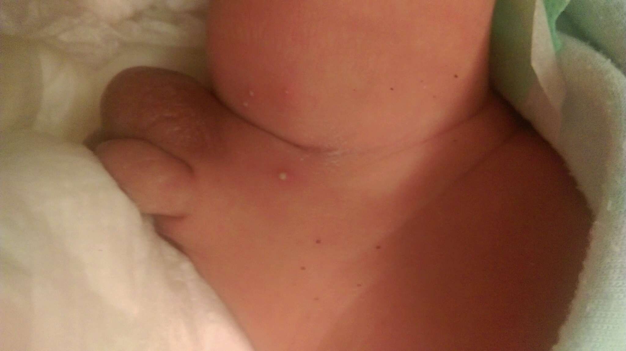 寶寶鼠蹊部附近長膿胞，怎麼辦?