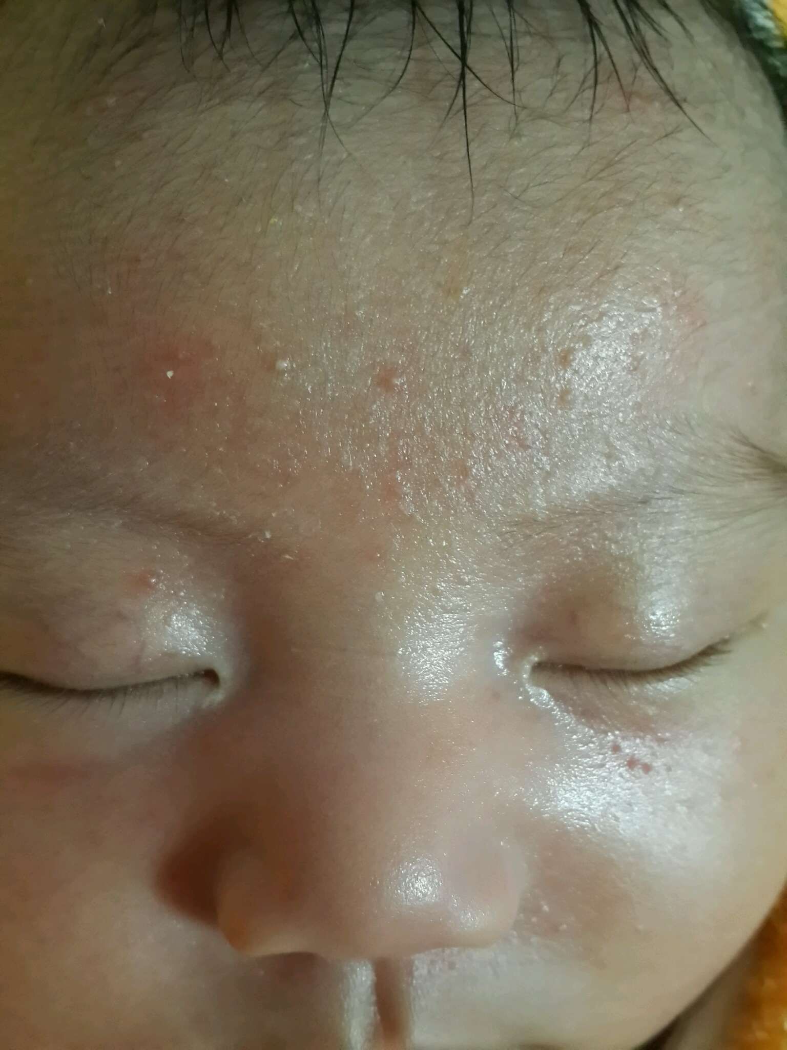 寶寶額頭長疹子還有放屁放不出來