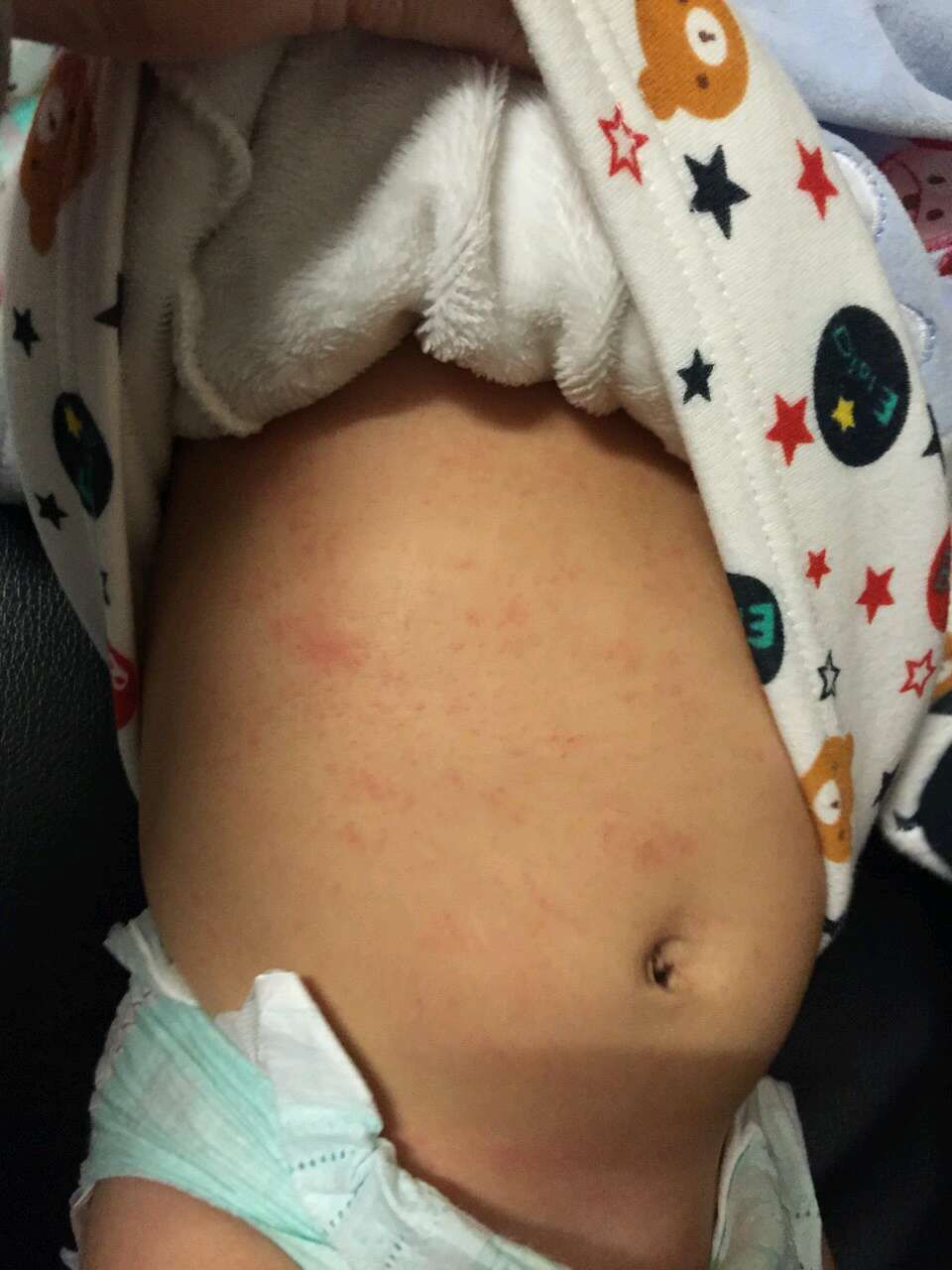 請問各位媽媽，我家寶貝是玫瑰疹嗎？